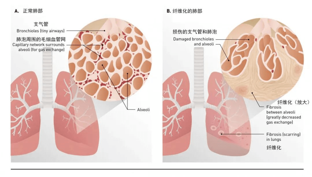 肺炎-呼吸訓(xùn)練器-基層肺功能-慢阻肺-哮喘-呼吸肌-排痰-肺功能檢測(cè)儀-賽客-新冠-疫情-病毒-康復(fù)